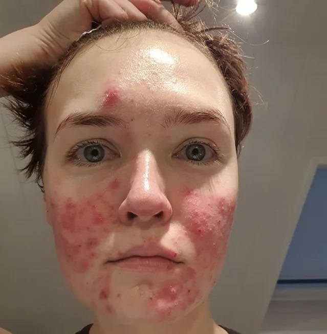 عوارض روتین پوستی